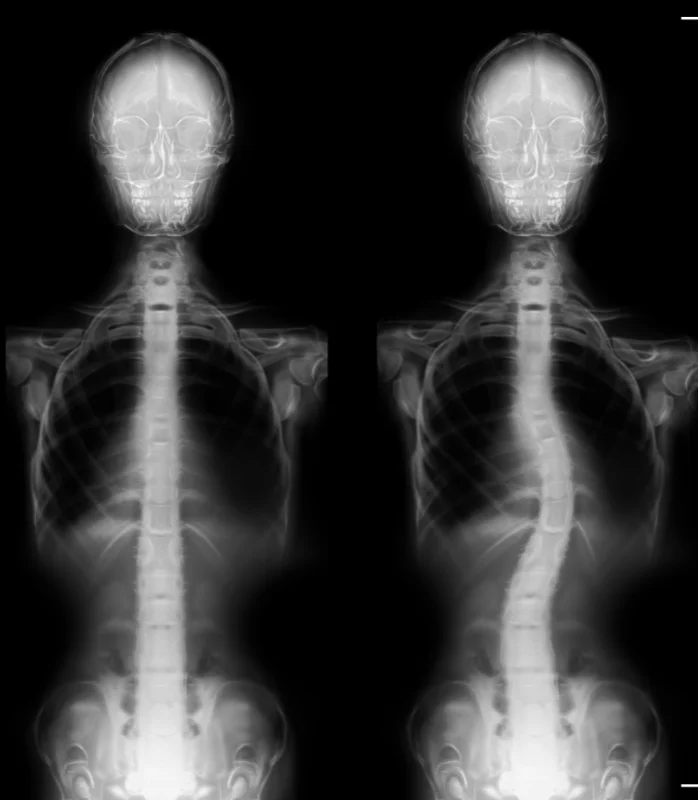 Scoliosis Treatment In Tustin